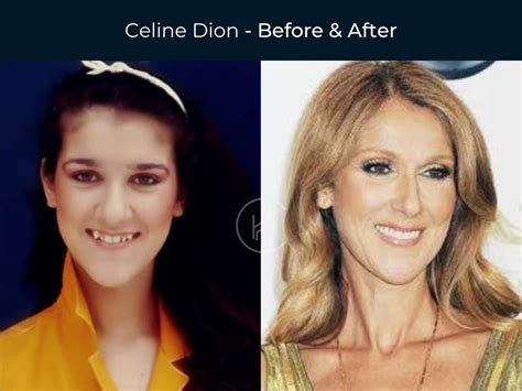 celine dion teeth